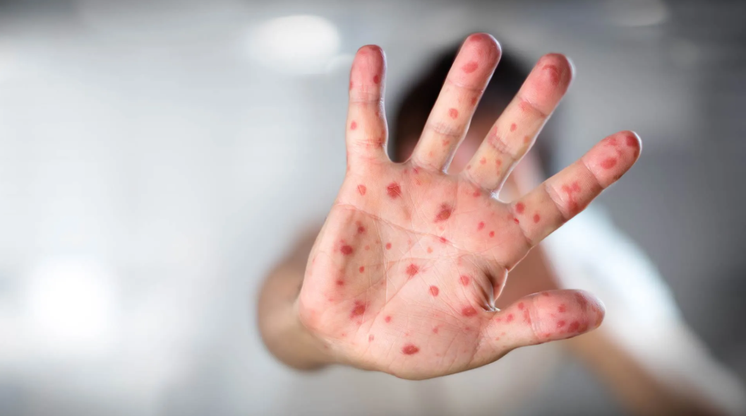 Refuerzan campaña de vacunación contra sarampión en Morelos